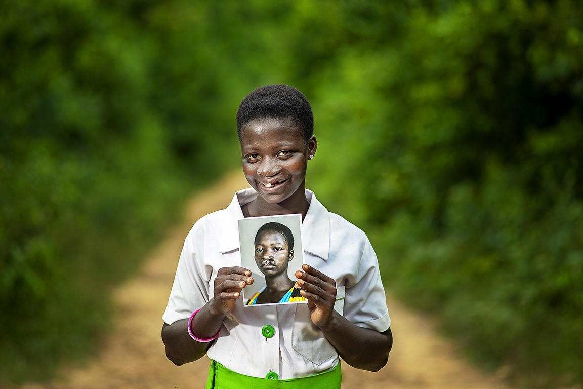 Operation Smile Koforidua patient Faustina Tsifokor.